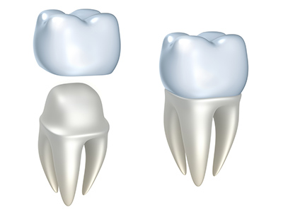 Computerized image of dental crowns.