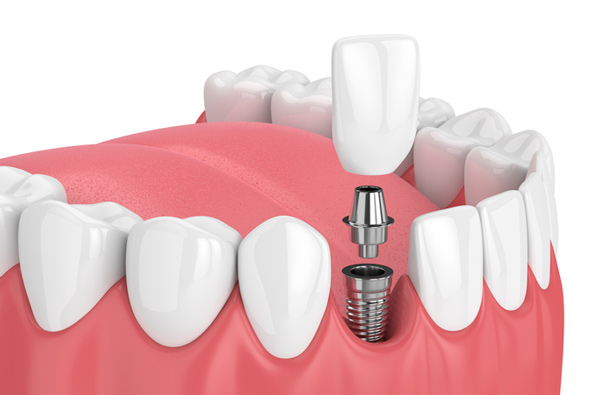 Rendering of jaw with dental implant at Premier Dental