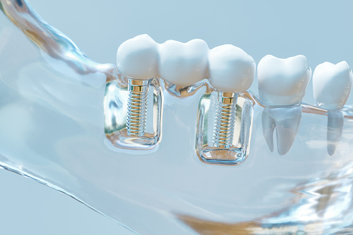 Image of a dental implant at Premier Dental.