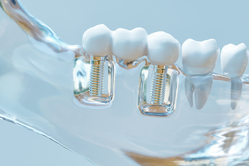 Image of a dental implant at Premier Dental Center.