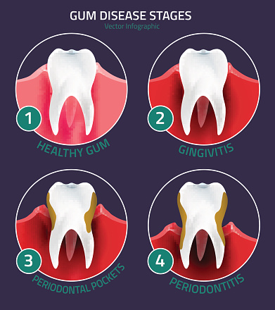 Image of Gingivitis