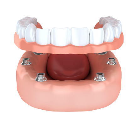 Implant denture graphic