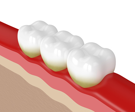 Image of Gingivitis