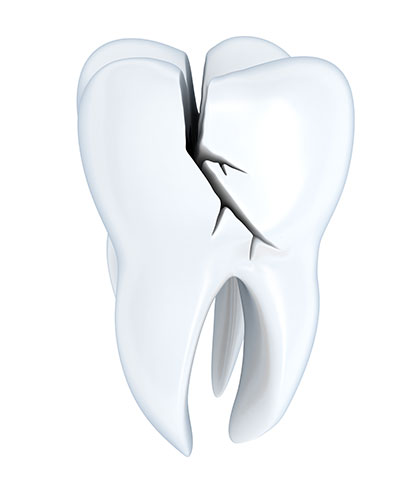 Signs Your Tooth is Starting to Crack