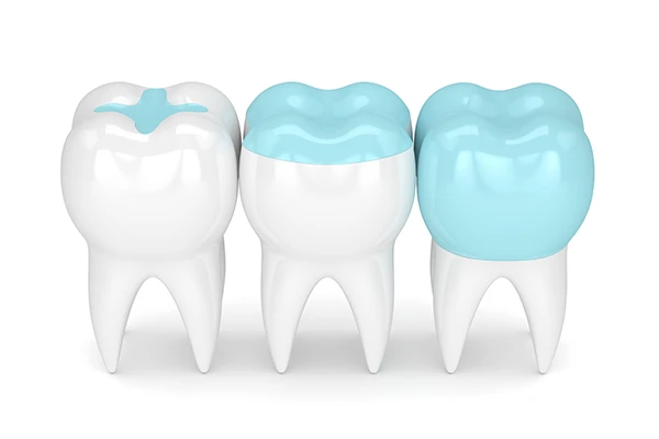 3D rendering of three teeth, one each with an inlay, onlay, and dental crown at Premier Dental