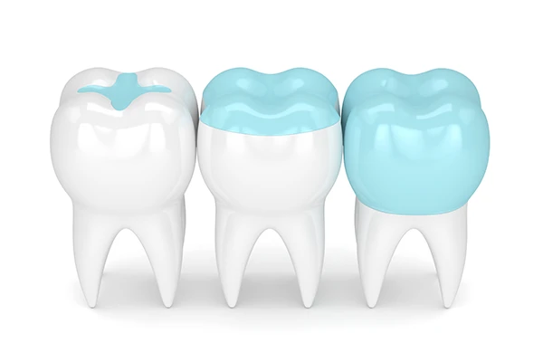 3D rendering of three teeth, one each with an inlay, onlay, and dental crown at Premier Dental Center