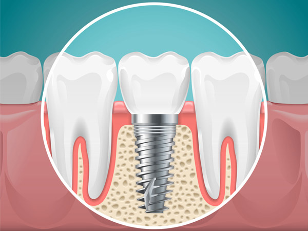 Diagram of a tooth replaced with a dental implant at Premier Dental
