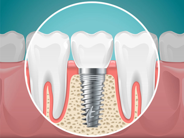 Diagram of a tooth replaced with a dental implant at Premier Dental Center