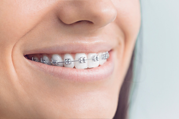 Close up of smiling woman with metal traditional braces at Premier Dental Center.