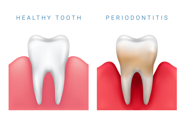 Healthy tooth vs. Periodontal disease image
