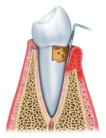 Image of Gingivitis