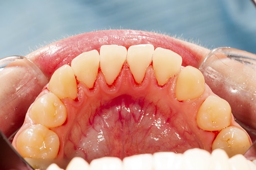 Symptoms of Gum Disease