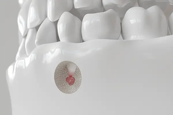 Apicoectomy animation
