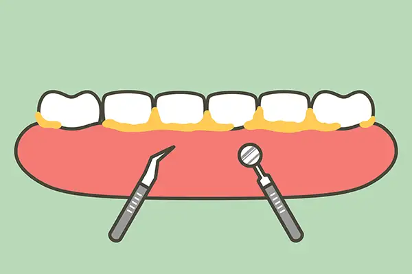 Dental tools used for removing plaque and tartar buildup from teeth during a deep cleaning procedure.